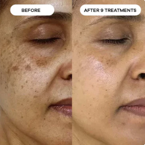 Peptide Micro-Infusion Kit™