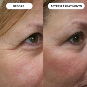 Peptide Micro-Infusion Kit™