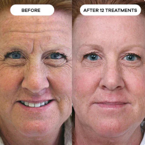 Peptide Micro-Infusion Kit™